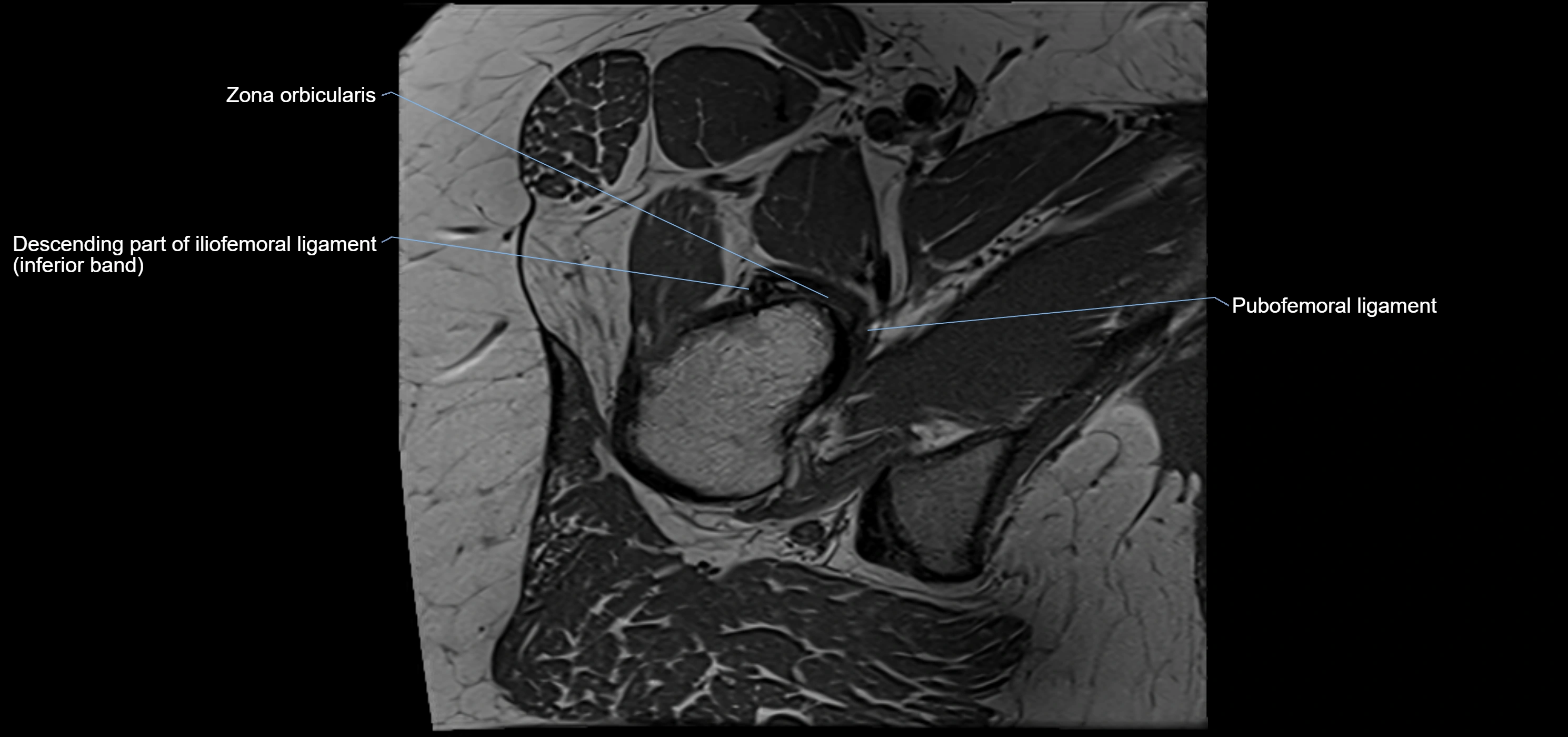 Hip ligament anatomy axial 3T MRI image -img-13001-00025.webp